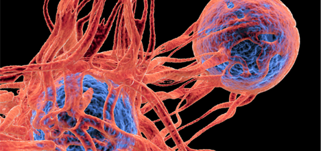 Cancer cells, showing the blood vessel formation providing the the cells with oxygens and nutrigens. 