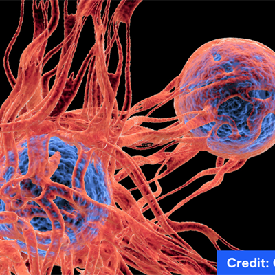 Cancer cells, showing the blood vessel formation providing the the cells with oxygens and nutrigens. 